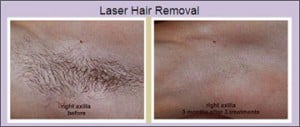 laser_hair_removal_2