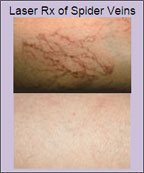 laser_hair_removal_3